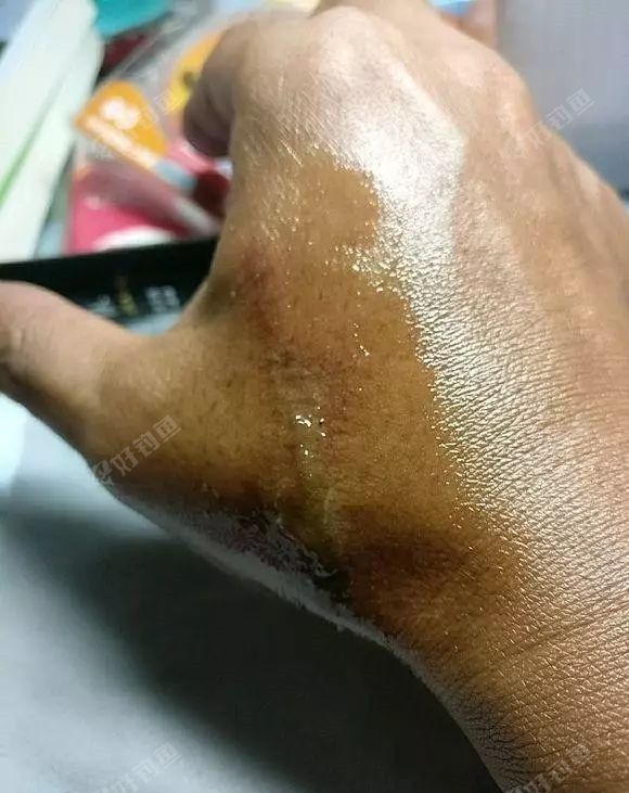 钓鱼被虫子咬了一下手就这样了