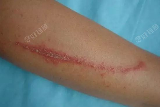 钓鱼被虫子咬了一下手就这样了