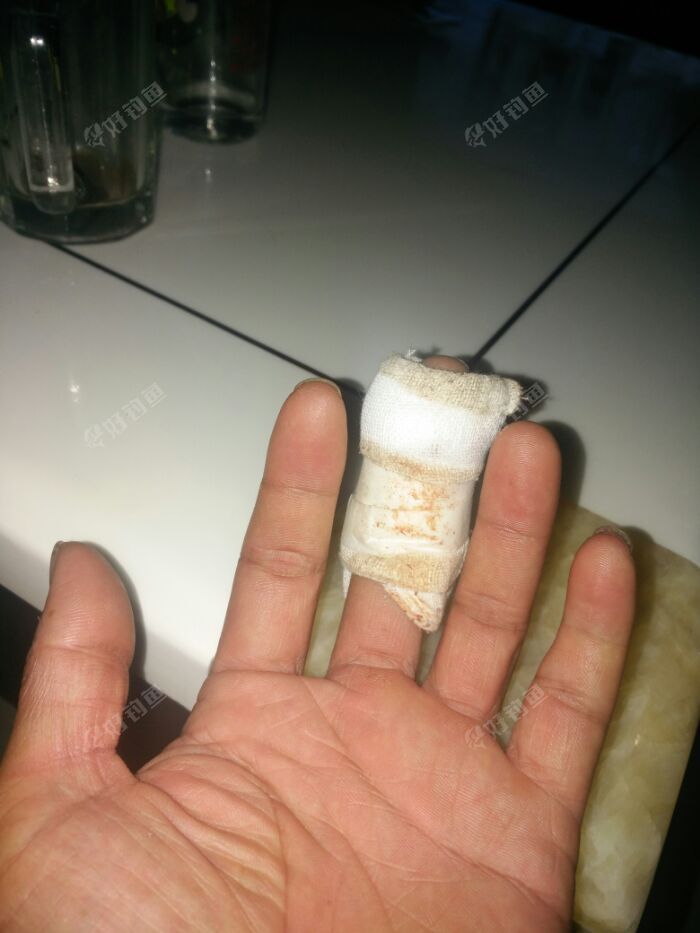 这是昨晚开车回家,老婆关车门时把我的手压了,还好没有伤骨所从今天